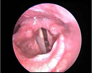 Fig. 3 - Pathological vocal cords