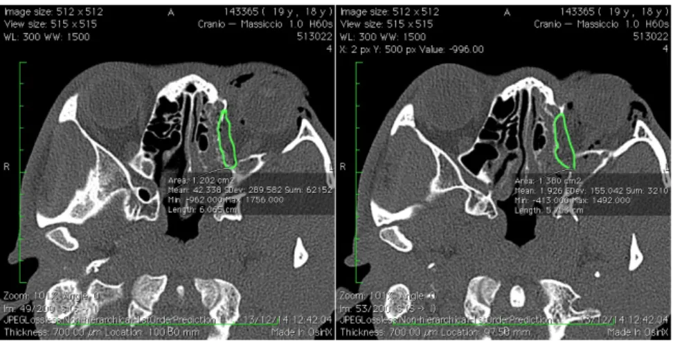 Fig.  5:  Misurazione  su  scansioni  TC  in  assiale  della  quota  di  tessuto  endo- endo-orbitario erniato