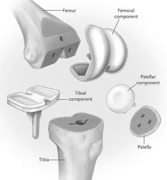 Figure II.5: Components of a knee replacement and their fixation points on 