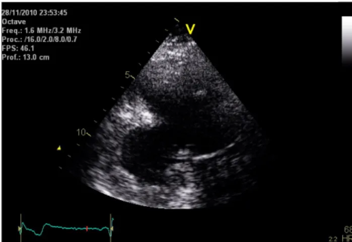 Figure 1. A dual-chamber echocardiografic view  showing a large posterior aneurism/pseudoaneurism