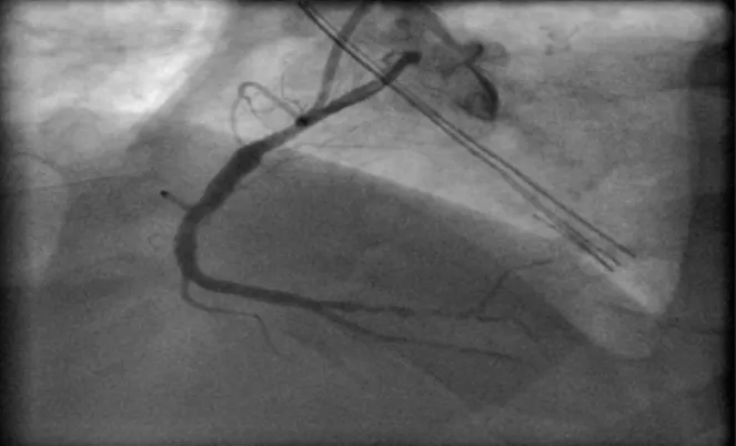 Figure 3.A distal critical stenosis of the right coronary  showed by coronary angiography