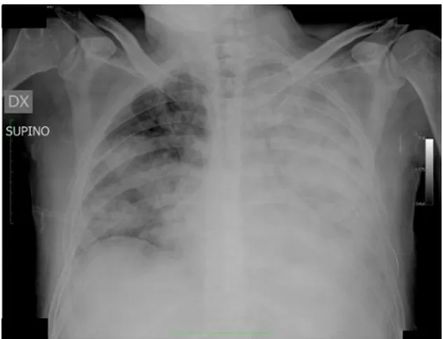 Figure 1. Chest x-ray at the admission in ER.  Evidence of large bilateral opacities.  