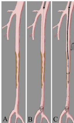 Fig. 1. Illustration of the Turbohawk™ device. A. Multiple preocclusive   SFA stenosis