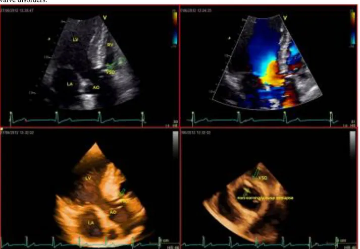 Figure 1. Echocardiographic Images.LV: left ventricle; RV: right ventricle; LA: left atrium; AO: aorta: VSD: ventricular septal 