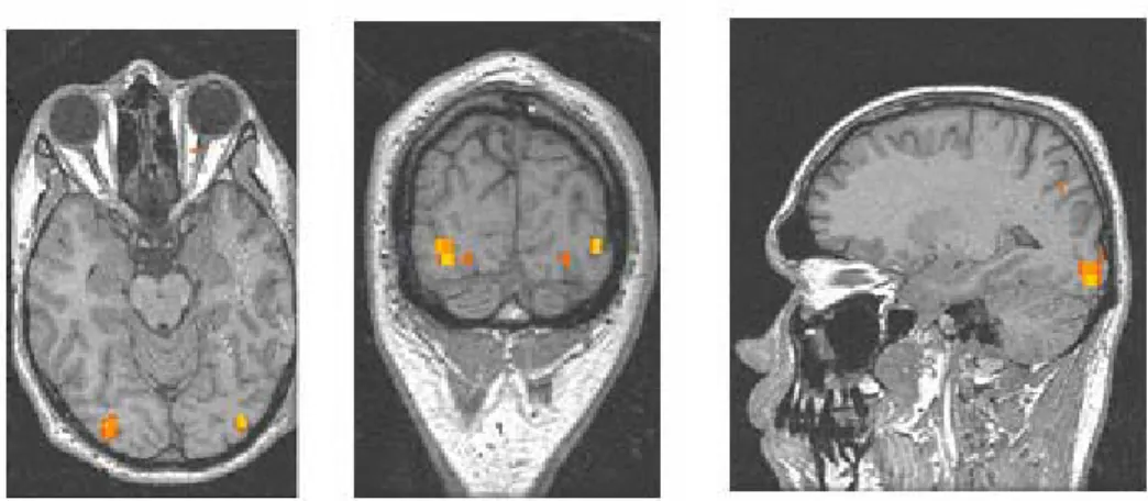 Fig 5.7 immagine anatomiche da sinistra verso destra: assiale, coronale, sagittale.  Le zona di attivazione primaria sono evidenziate con colori rossi