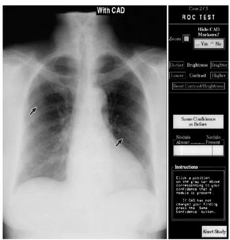 Figura 1.3: il display per il riconoscimento dei noduli usato per  l’esperimento. Le frecce poste sulla radiografia rappresentano  