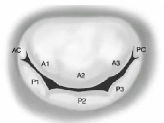 Fig. 3: anterior and posterior mitral leaflets, subdivided in P1, P2, P3 and A1,  A2  and  A3  respectively