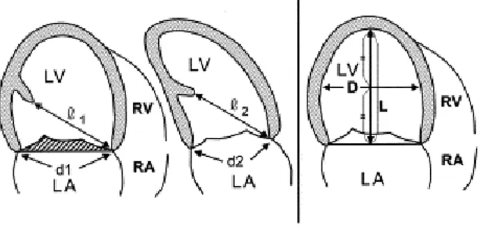 Fig.  9 :   left  ventricular  diameters  and  ischemic  mitral  regurgitation : for details see text