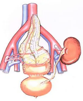 Figura 6-Trapianto di pancreas con drenaggio sistemico vescicale.