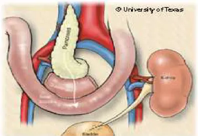 Figura 7-Trapianto di pancreas con drenaggio sistemico enterico.