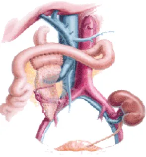 Figura 8-Trapianto di pancreas con drenaggio enterico portale, si può osservare che la porzione duodenale del Graft   è   anastomizzata   con   l’ileo   del   paziente,   mentre   l’organo   viene   vascolarizzato   attraverso   il confezionamento di un’an