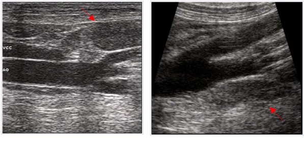 Fig. 3.2: A) Linfonodo iliaco mediale destro (freccia); VCC:vena cava caudale;