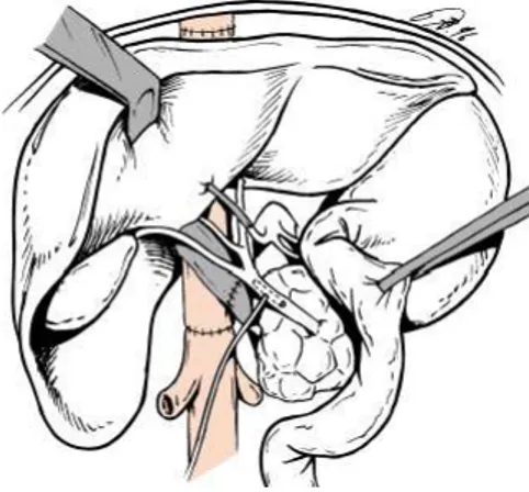 Fig 1 trapianto ortotopico di fegato 