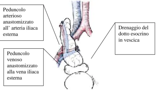 Figura 1-Trapianto di pancreas con drenaggio sistemico vescicale