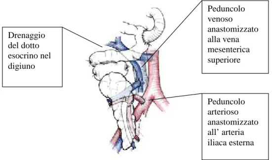 Figura 3-Trapianto di pancreas con drenaggio enterico portale. 