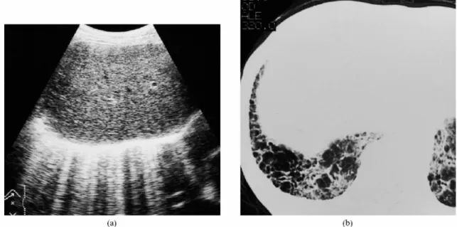 Fig.  1.  Donna  di  71  anni  con  fibrosi  polmonare  idiopatica.  (a)  Scansione  ecografica sottocostale del fegato che mostra numerosi artefatti