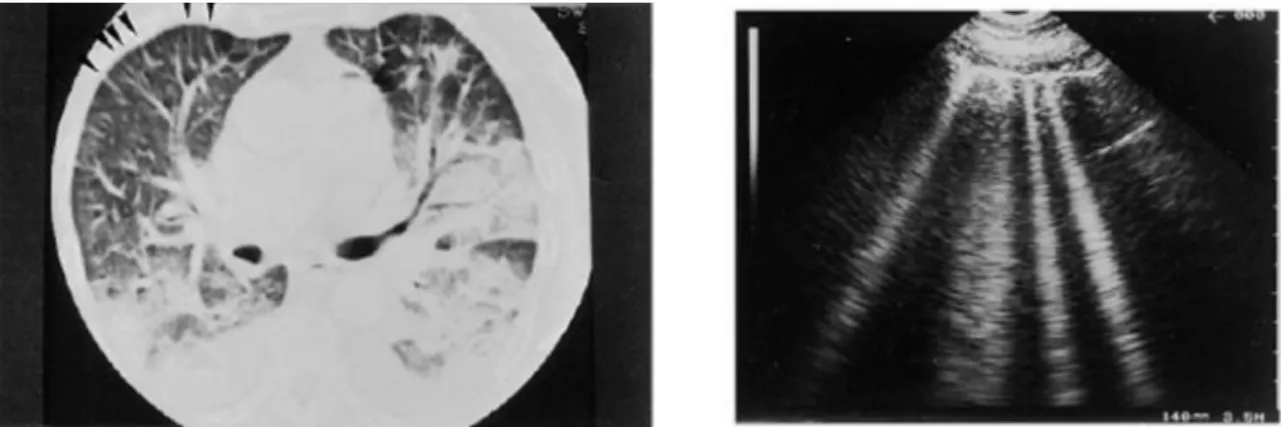 Fig. 3. Edema polmonare acuto. (Sinistra) TC: setti interlobulari ispessiti sono chiaramente visibili a livello della superficie anteriore del polmone (frecce)