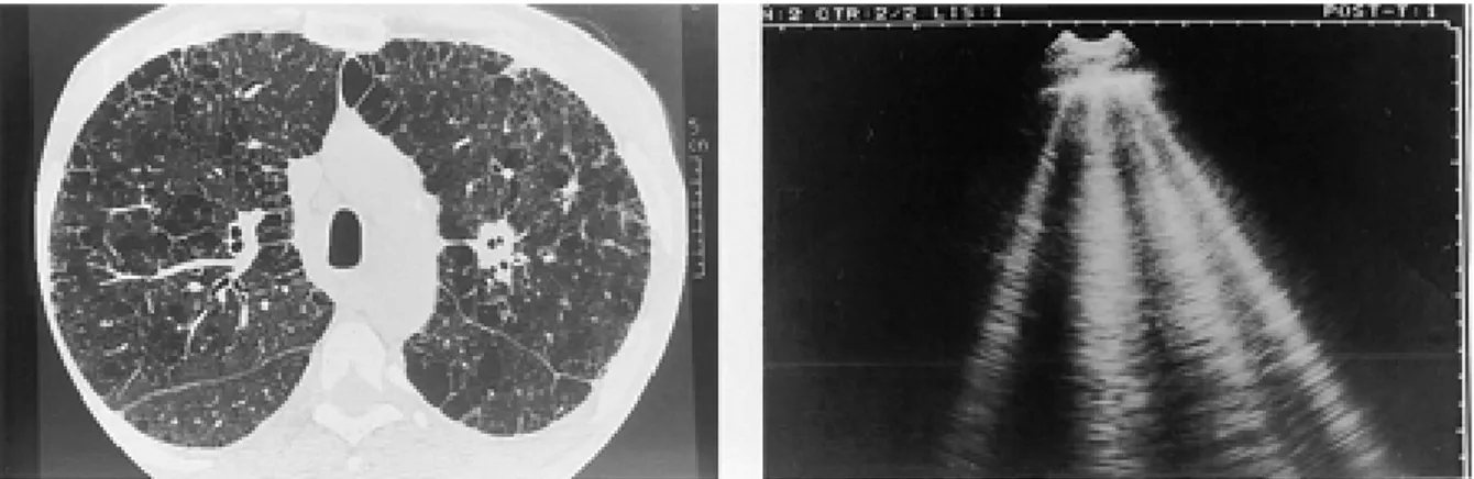 Fig.  5.  Fibrosi  interstiziale  diffusa.  (Sinistra)  TC:  si  possono  osservare  setti  interlobulari ispessiti  su  tutta  la  superficie  del  polmone