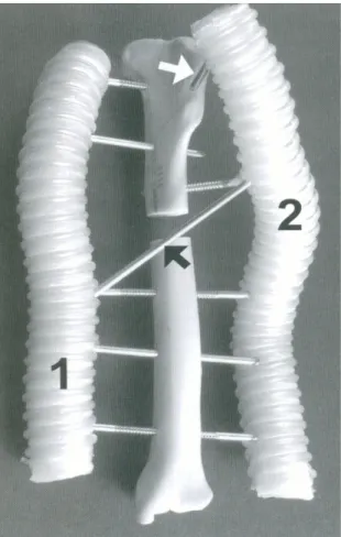 Figura 2.2: fissatore esterno di tipo acrilico. In questo caso i tubi flessibili  prendere il posto delle barre di connessione.