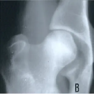 Figura 1.4: immagine  radiografica di  un’articolazione  coxofemorale; si nota  una leggera  incongruenza 