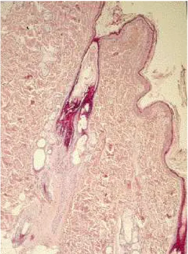 Fig. 5.5.1.A: Aspetto istologico caratteristico dell’alopecia ciclica dei fianchi: infundiboli dilatati e follicoli secondari atrofici, a  formare la “figura a polipo” (ematossilina eosina, 40x)
