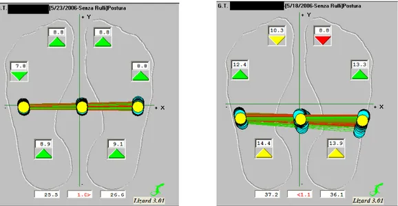 Fig 7. Andamento dei carichi posturali visualizzati in tempo reale durante la registrazione 