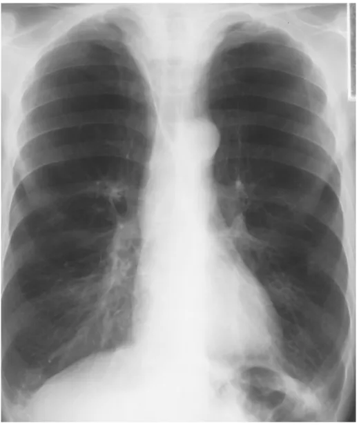 Figura 2: Radiografia del Torace in Proiezione Antero-Posteriore 