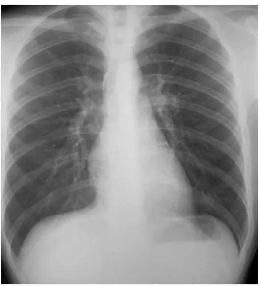 Figura   3:  Radiografia   del   torace.   Proiezione   Antero-Posteriore 