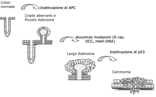 Figura 1. – Evoluzione epitelio normale - carcinoma. 