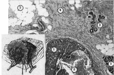 Fig. 1.3  Sezione di un carcinoma al seno, che mette in risalto l’alta eterogeneità  del tessuto