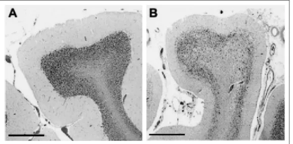 Figura 2.5 A. Cellule di Purkinje in un cervelletto normale, B. Riduzione del numero di 