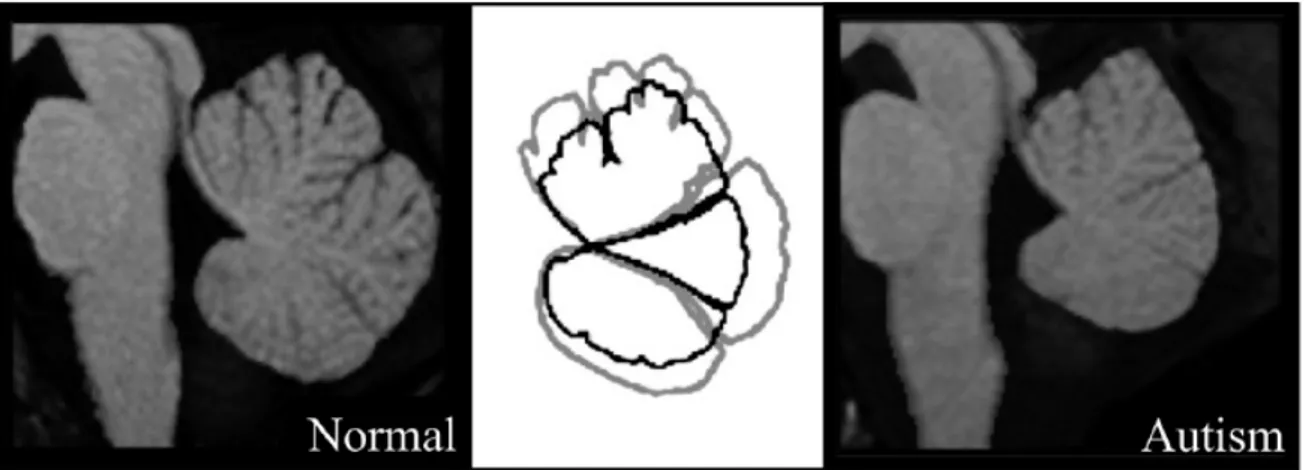 Figura 2.7 Immagini di RM che rappresentano il cervelletto di un soggetto normale e di 
