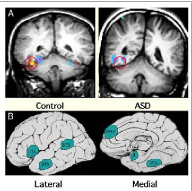 Figura 2.9 Anormalità funzionali nel cervello autistico A. Immagine di fMRI che mostra 