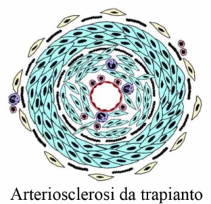 Figura 5 Schema : Nell'arteriosclerosi da trapianto, l'intera parete del l'arteria è implicata con  conseguente formazione di una lesione “concentrica„