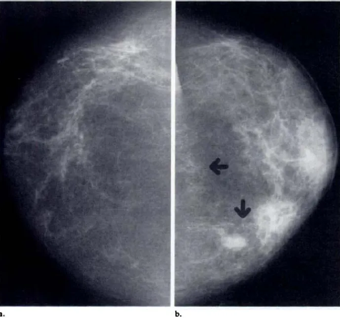 Figura 5: Mammografie di una donna di 62 anni con pelle ispessita, 