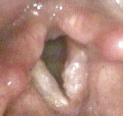 Figura 4: Carcinoma della corda vocale sinistra (stadio I). 