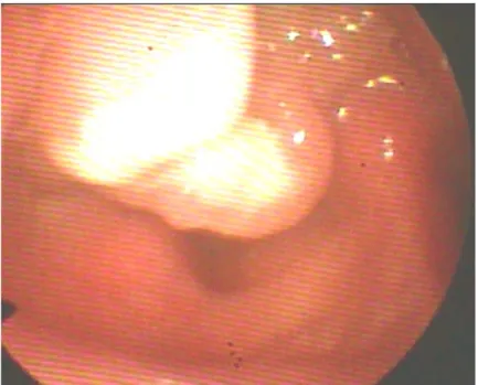 Figura 5: Carcinoma della sovraglottide (stadio III) 