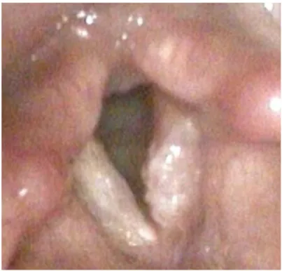 Figura 4: Carcinoma della corda vocale sinistra (stadio I). 