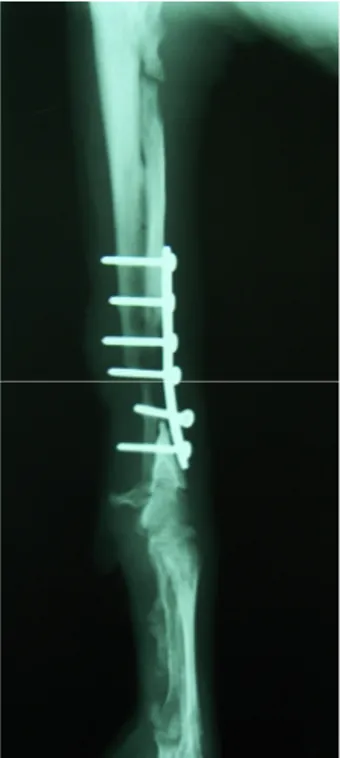 Figura 7.5: Aspetto radiografico di diastasi e sclerosi dei monconi. 