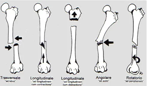 Figura 2.2.b: Classificazione delle fratture in base allo spostamento dei capi ossei             (Brunetti 