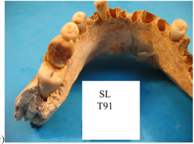 Figura 1: Particolari di affezioni dentarie nel campione di San Sebastiano: in a) carie mesiale di P1 s, in b) caso 