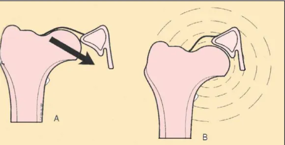 Figura 14 Il rumore di “clunk” prodotto dall’anca durante la deambulazione è causato dalla riduzione del 