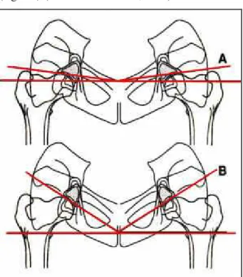 Figura  24  schema  della  proiezione  del  margine  acetabolare  dorsale  che  illustra  la  differenza  della 