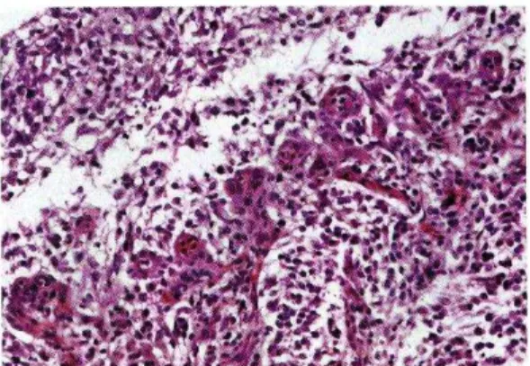 FIG  251  AStrocitoma  pag  225  Astrocitoma  protoplasmatico:  notare  la  caratteristica  neovascolarizzazione  periferica  sottoforma  di  glomerulizzazione,   gentilmente concessa da Mandara MT)   