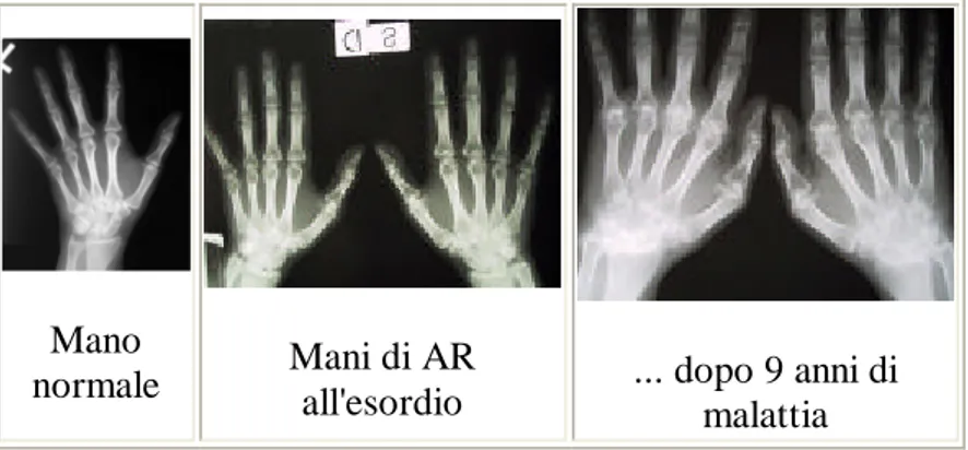 Figura 5: evoluzione delle lesioni articolari in pazienti con AR 