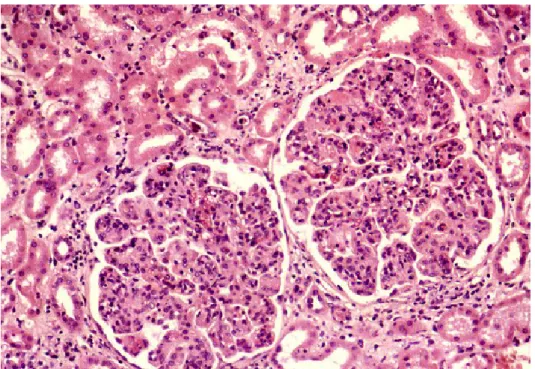Fig.   3.Glomerulonefrite   crioglobulinemica:   lesioni   membranoproliferative   con   notevole  ipercellularità, aumento di volume e lobulazione glomerulare (in M.O.)