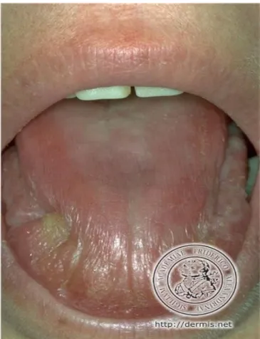 fig. 8.Secchezza ed arrossamento della mucosa orale in corso di sindrome sicca.