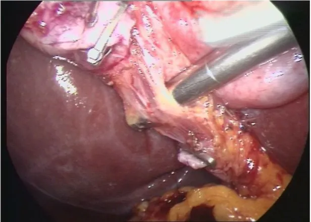 Fig 1-colecistectomia laparoscopica :identificazione dell’arteria cistica