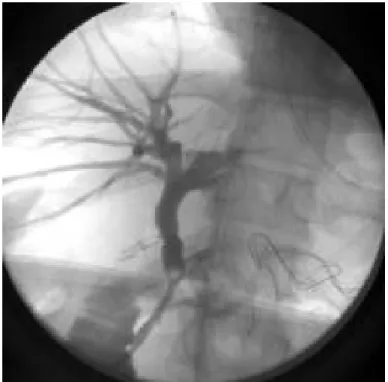 Fig 5 colangiografia intraoperatoria : marcata dilatazione delle vie biliarir  epresenza di un vistosa immagine di minus poi rivelatasi una formazione  litiasica