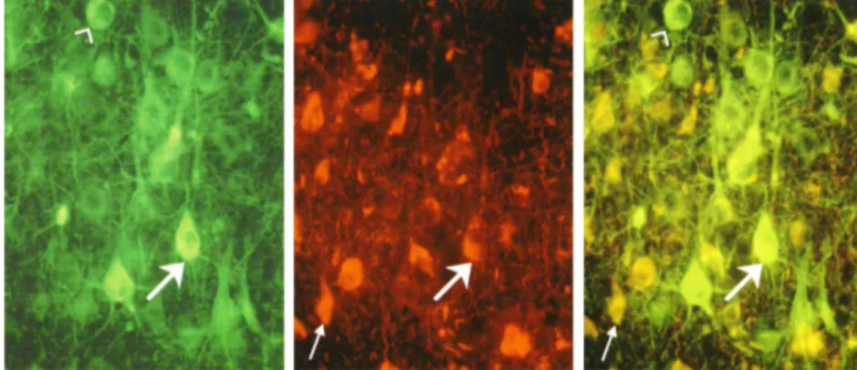 Figura  3    Neuroni  di  un  paziente  con  Alzheimer.  I  neuroni  normali  contengono 